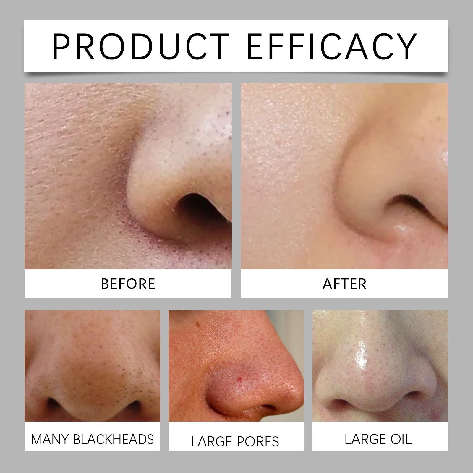 Hoygi Mitesser-Nasenmasken-Set