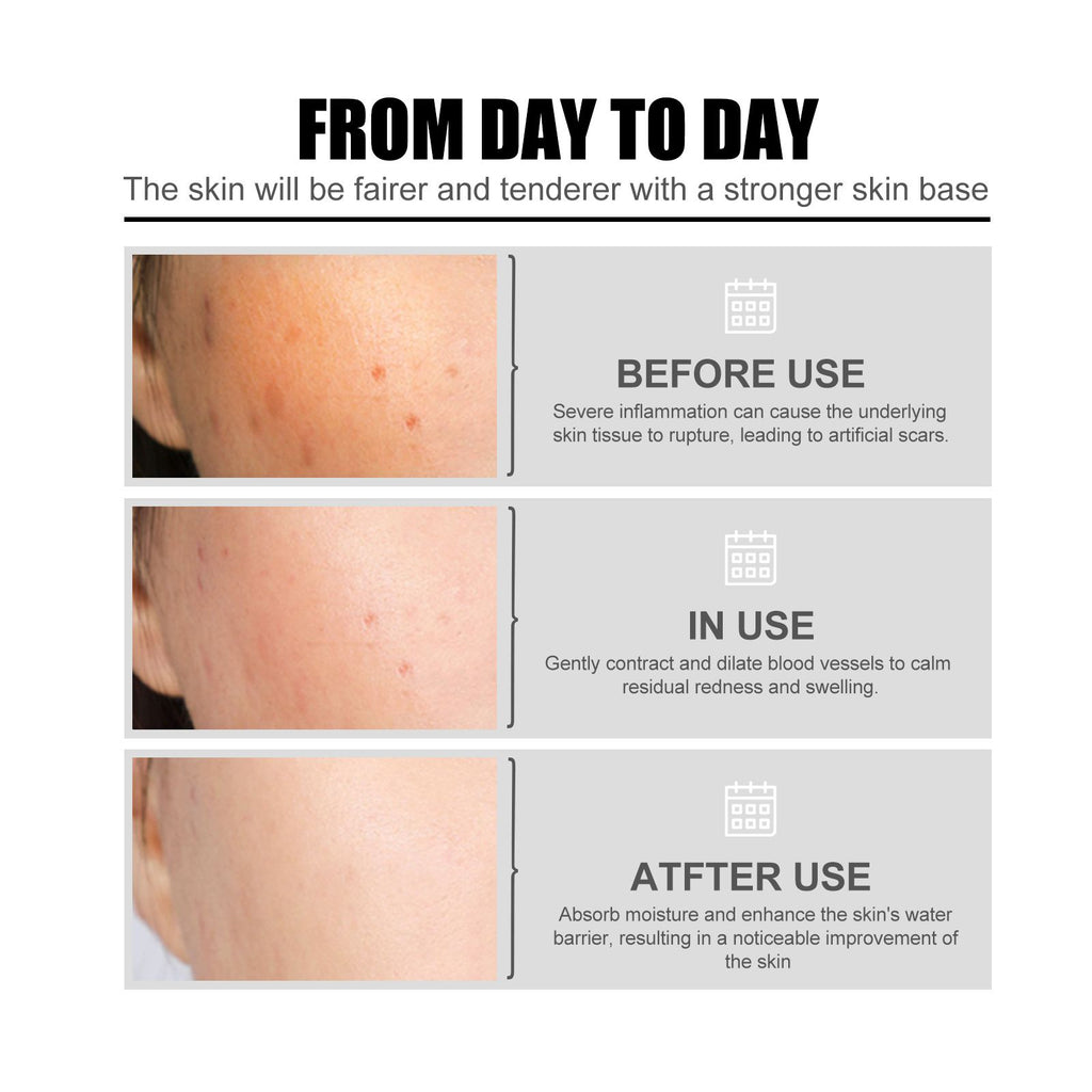 EELHOE Nicotinsäure-Gesichtsessenz zur Aufhellung von Akneflecken, Feuchtigkeit der Poren, Hautstraffung und -aufhellung – Schönheitsessenz