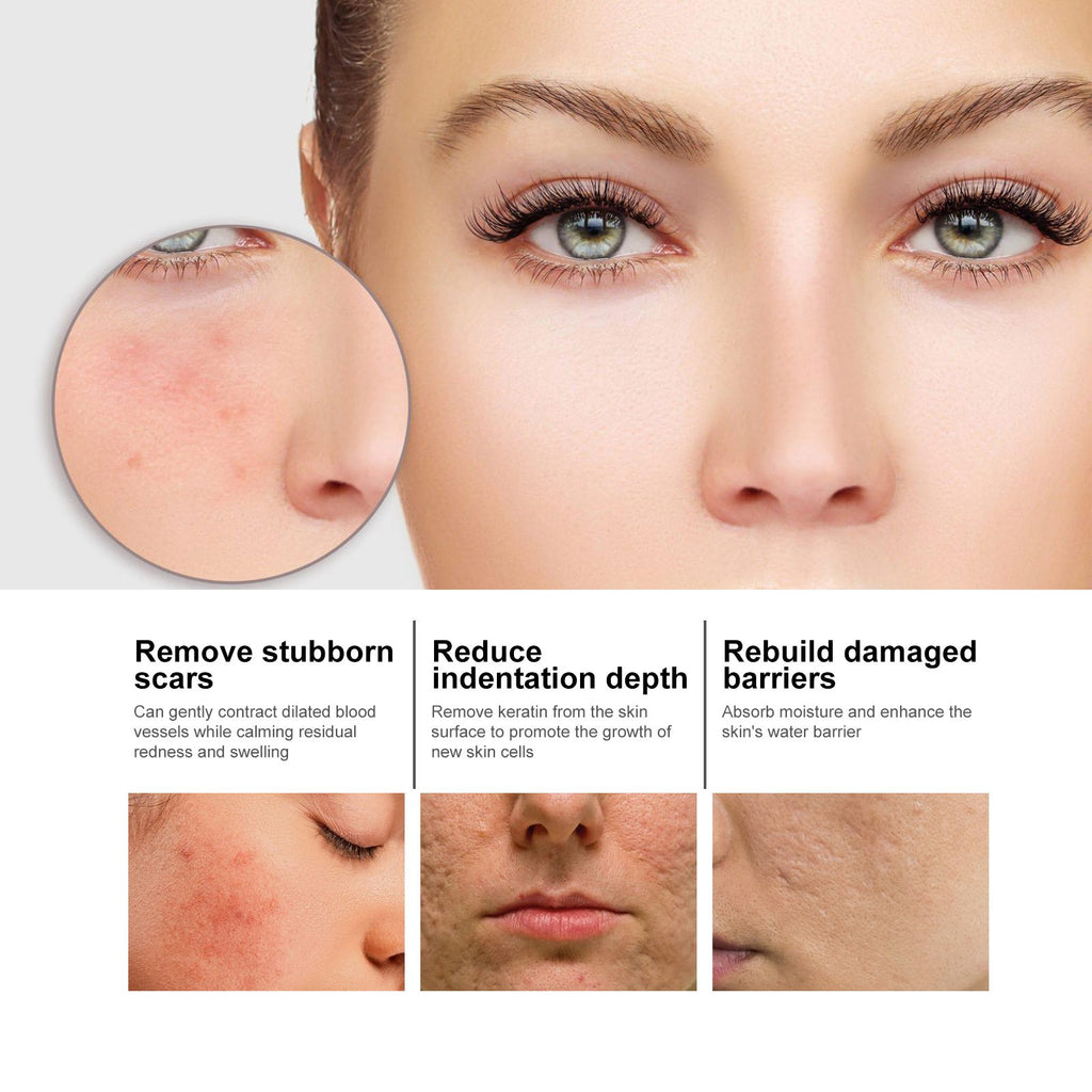 EELHOE Nicotinsäure-Gesichtsessenz zur Aufhellung von Akneflecken, Feuchtigkeit der Poren, Hautstraffung und -aufhellung – Schönheitsessenz