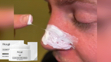 Hoygi Mitesser-Nasenmasken-Set