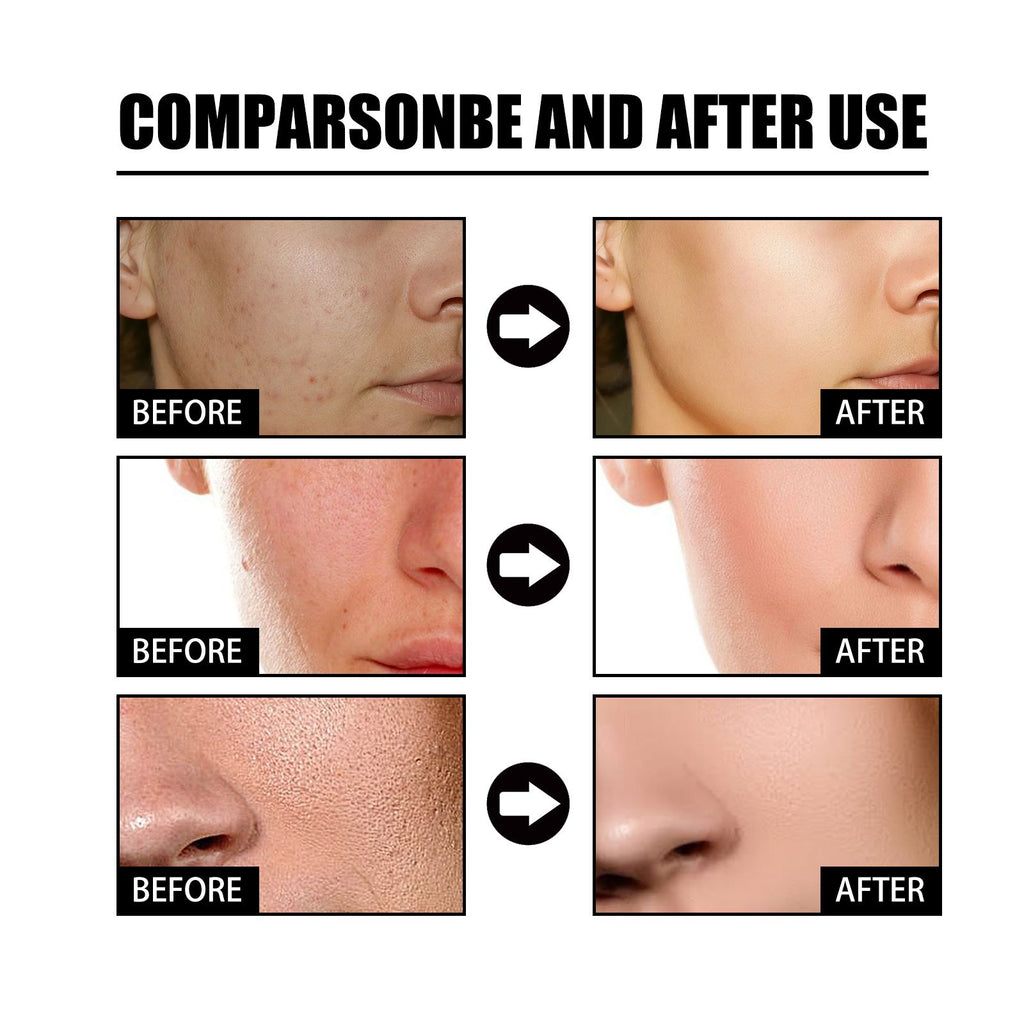 EELHOE Nicotinsäure-Gesichtsessenz zur Aufhellung von Akneflecken, Feuchtigkeit der Poren, Hautstraffung und -aufhellung – Schönheitsessenz